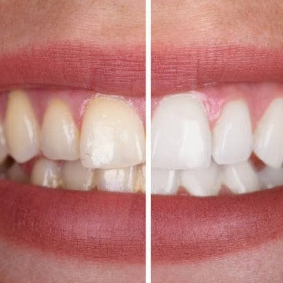 Gel blanchissant - Pour un sourire éclatant